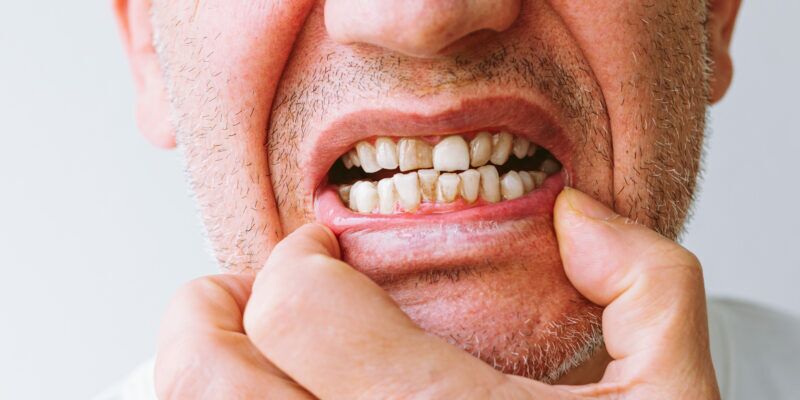 Doença Periodontal: Causas, Sintomas e Tratamentos Doença Periodontal: Causas, Sintomas e Tratamentos